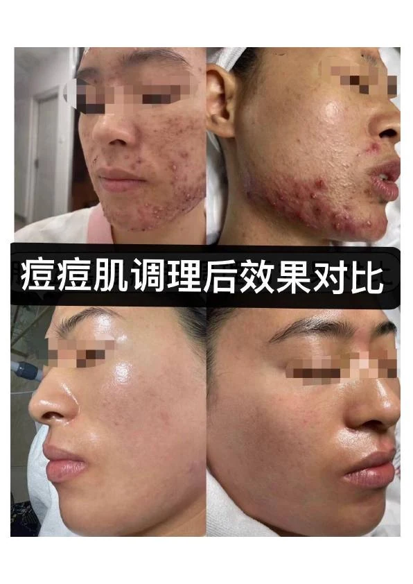 面部痤疮阶段改善对比