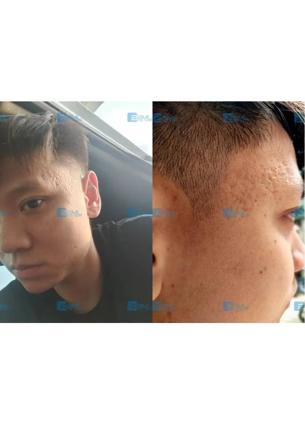 面颊痘坑肤质改善对比