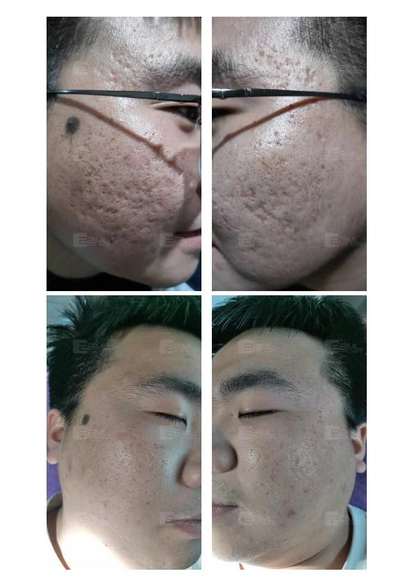 面部痘坑阶段改善记录