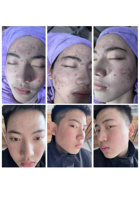 面部痤疮综合改善记录