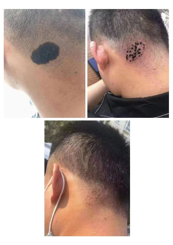 头颈部胎记改善记录
