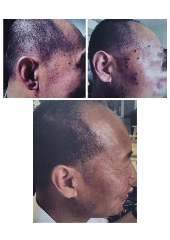 面部皮肤赘生物改善记录