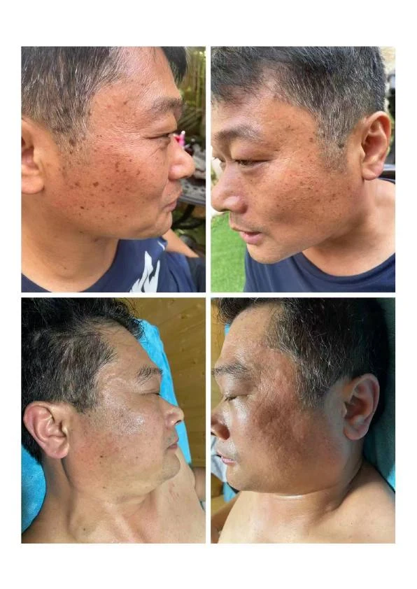 面部扁平疣阶段对比