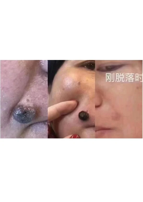 面部色素痣改善对比
