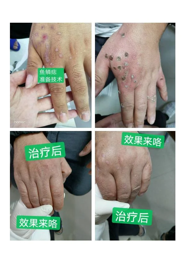 手部色素痣改善记录