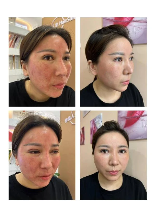 敏感泛红综合修护对比