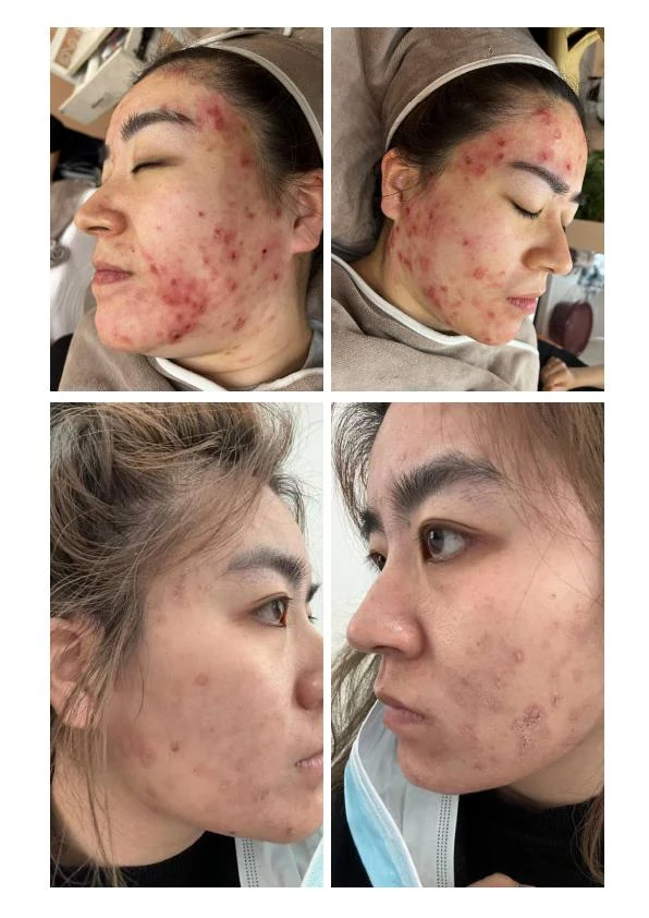 面颊泛红修护阶段对比