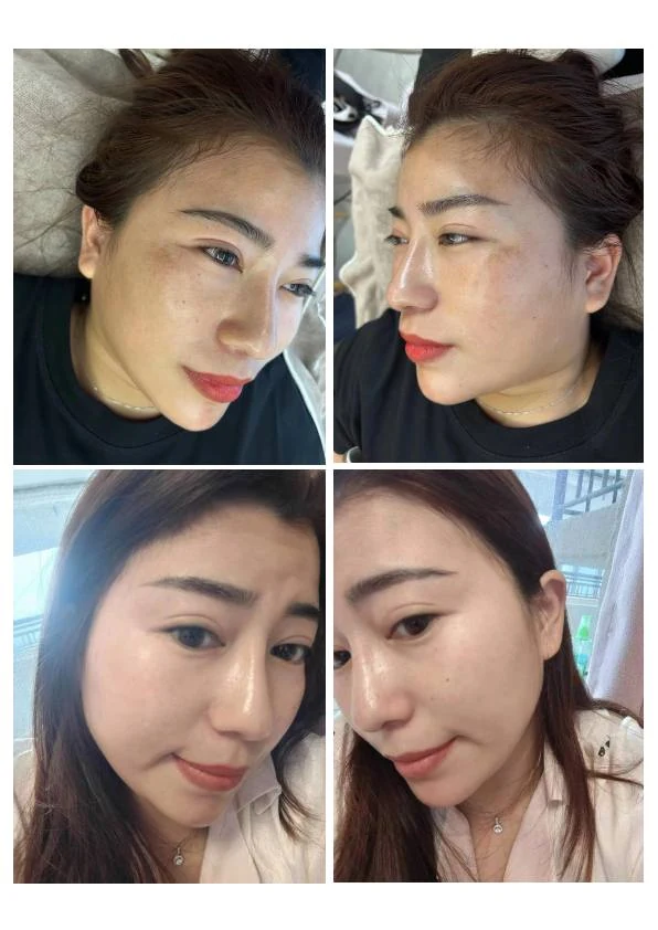 面部黄褐斑淡化对比