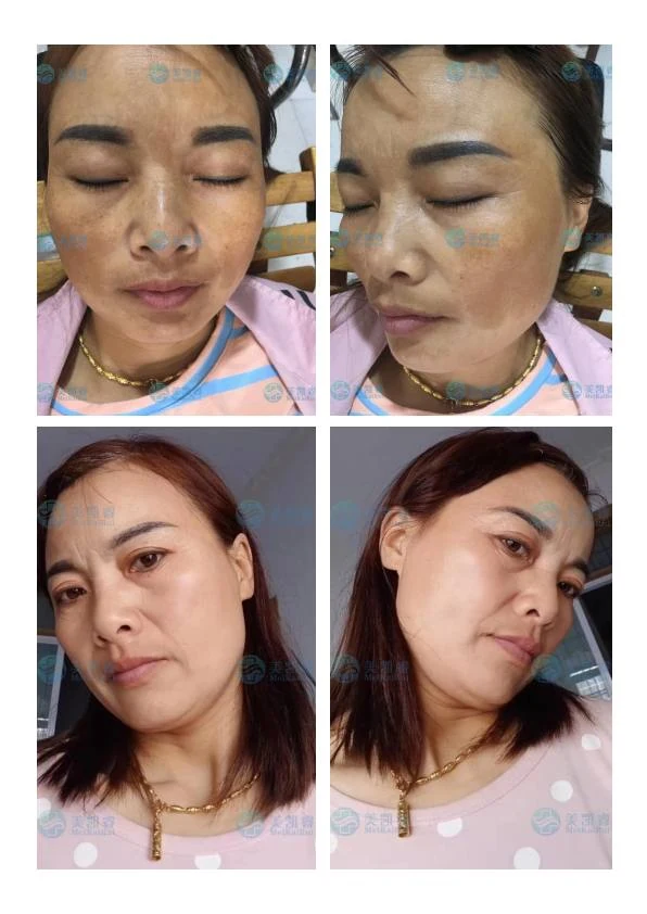 面部铅汞斑修护对比