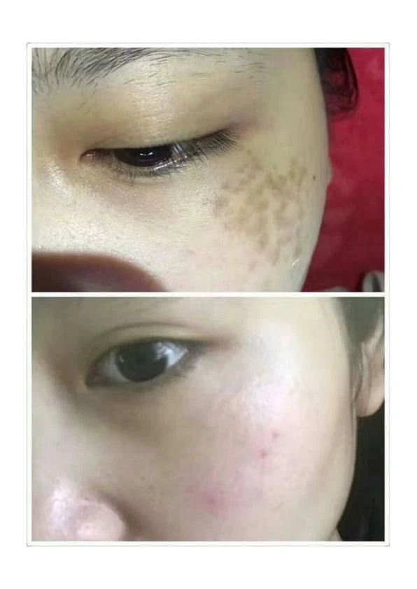 眼周真皮斑改善对比