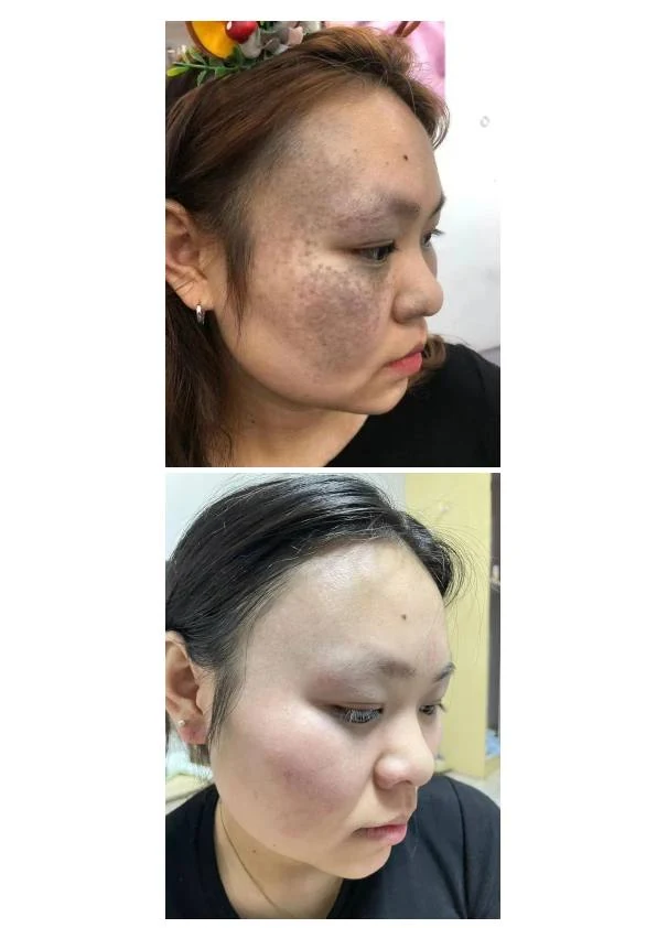 面颊真皮斑淡化记录