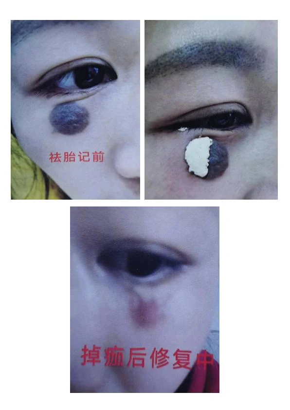 胎记改善阶段记录 03