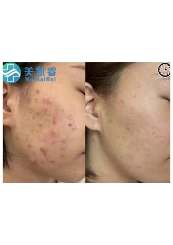 面部痤疮改善阶段记录 04