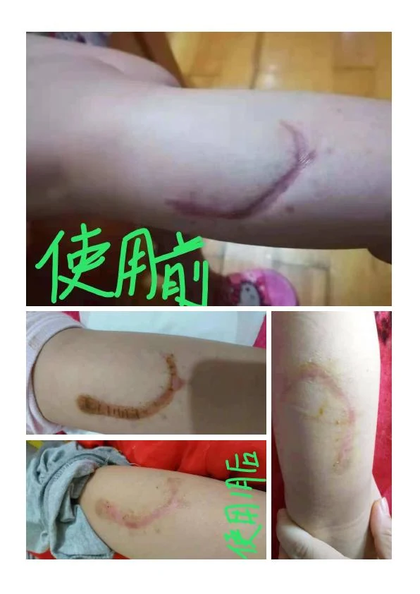 小腿外伤疤痕改善记录