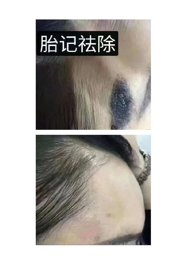 胎记改善阶段记录 01