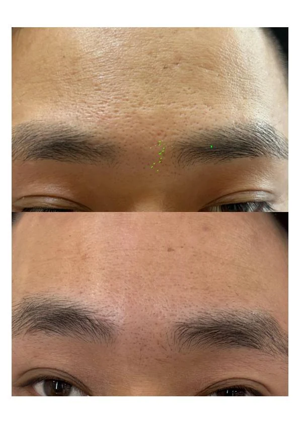 额部痘坑改善对比