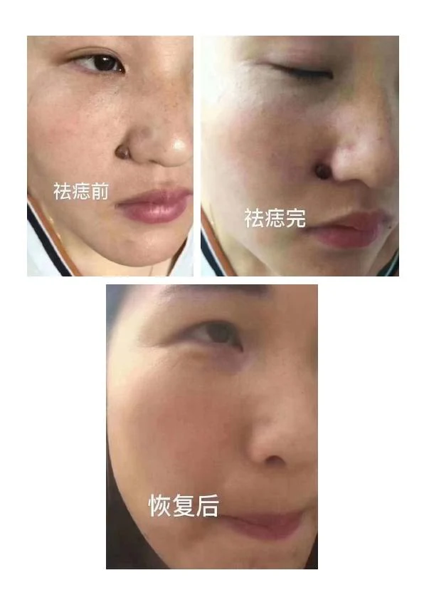 色素痣改善阶段记录 01