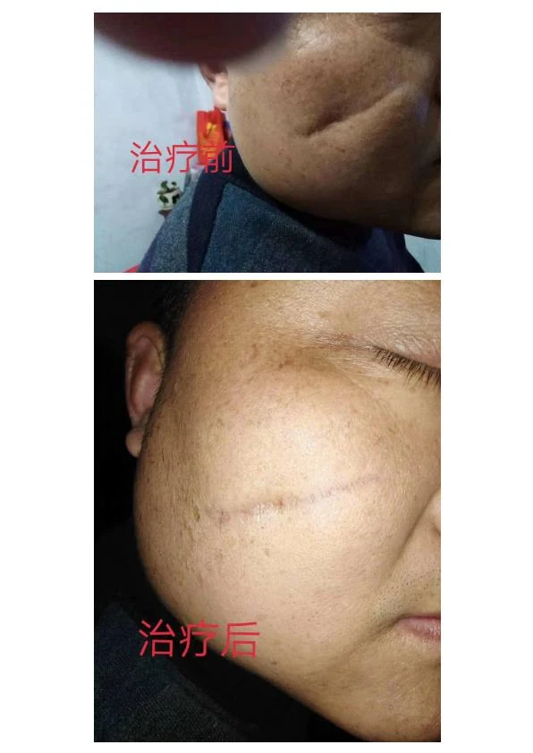 面部凹陷疤痕改善记录