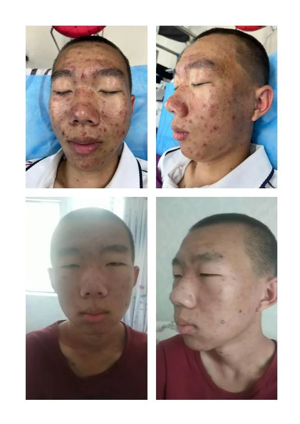 敏感泛红修护阶段记录 02