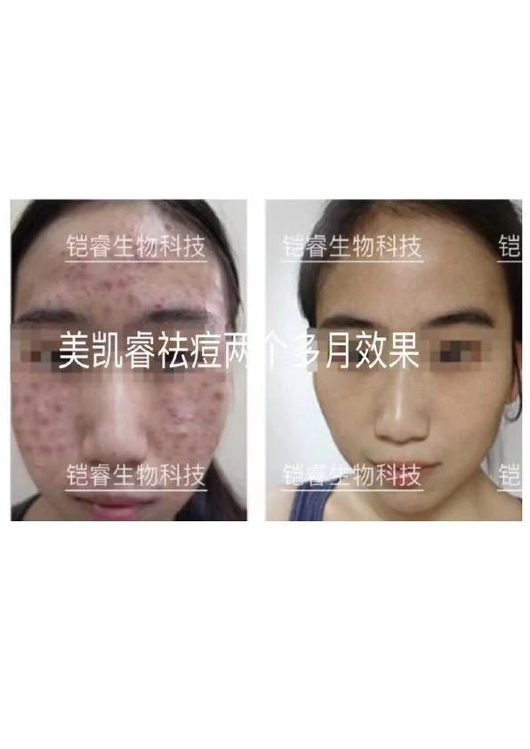 面部痤疮改善阶段记录 12
