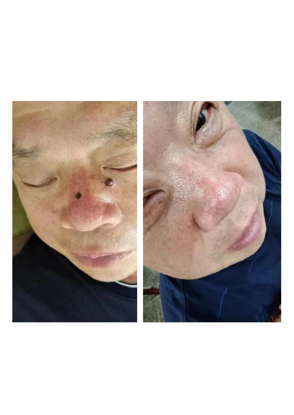 色素痣改善阶段记录 04