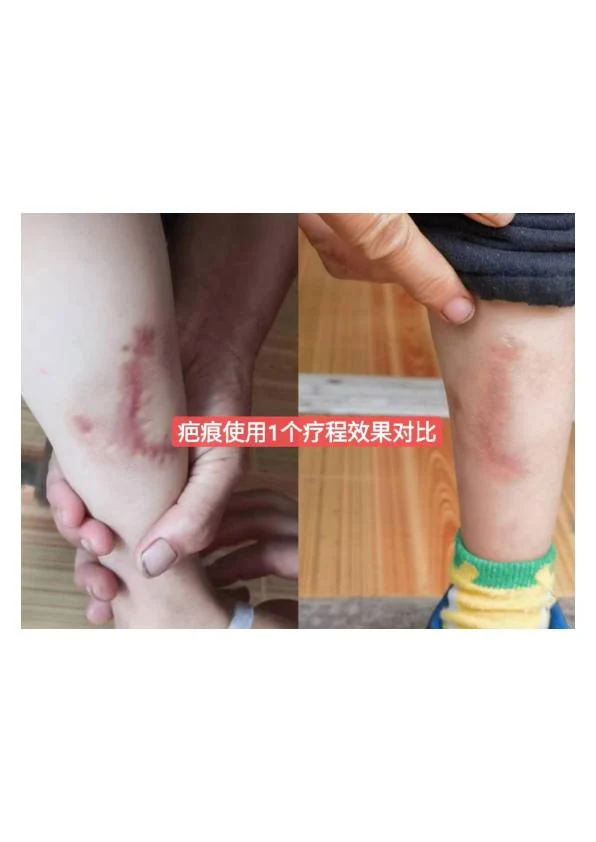 儿童肢体增生疤痕改善记录