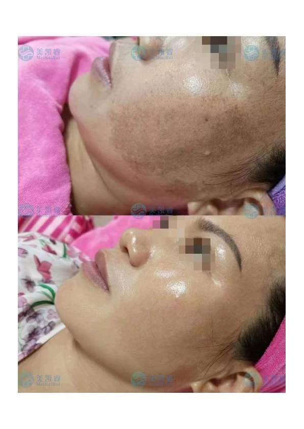 铅汞斑修护阶段记录 01