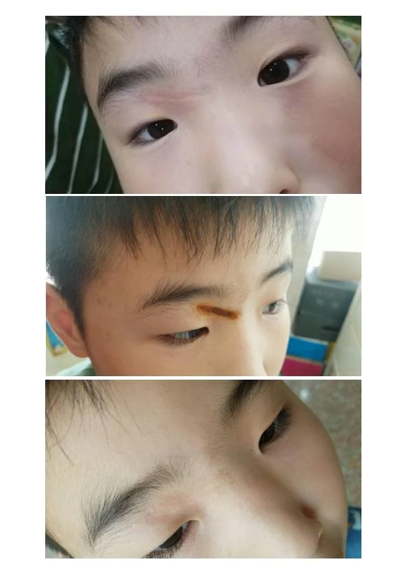 眼周创伤疤痕改善记录