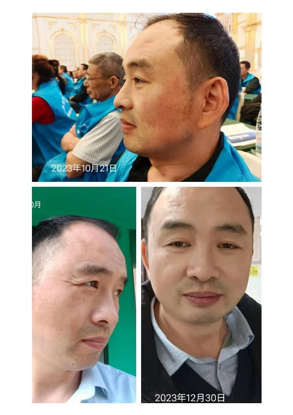 铅汞斑修护阶段记录 03