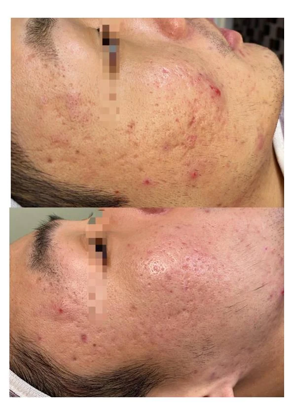 面部痤疮改善阶段记录 10