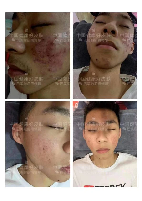 面部痤疮改善阶段记录 01