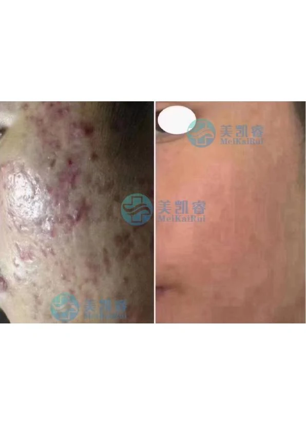 面部痤疮改善阶段记录 11