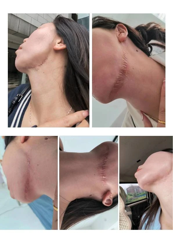 颈部术后增生疤痕改善记录