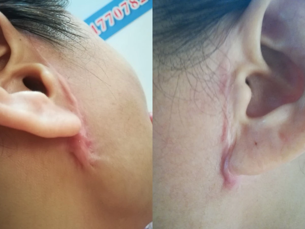 耳后增生疤痕改善对比
