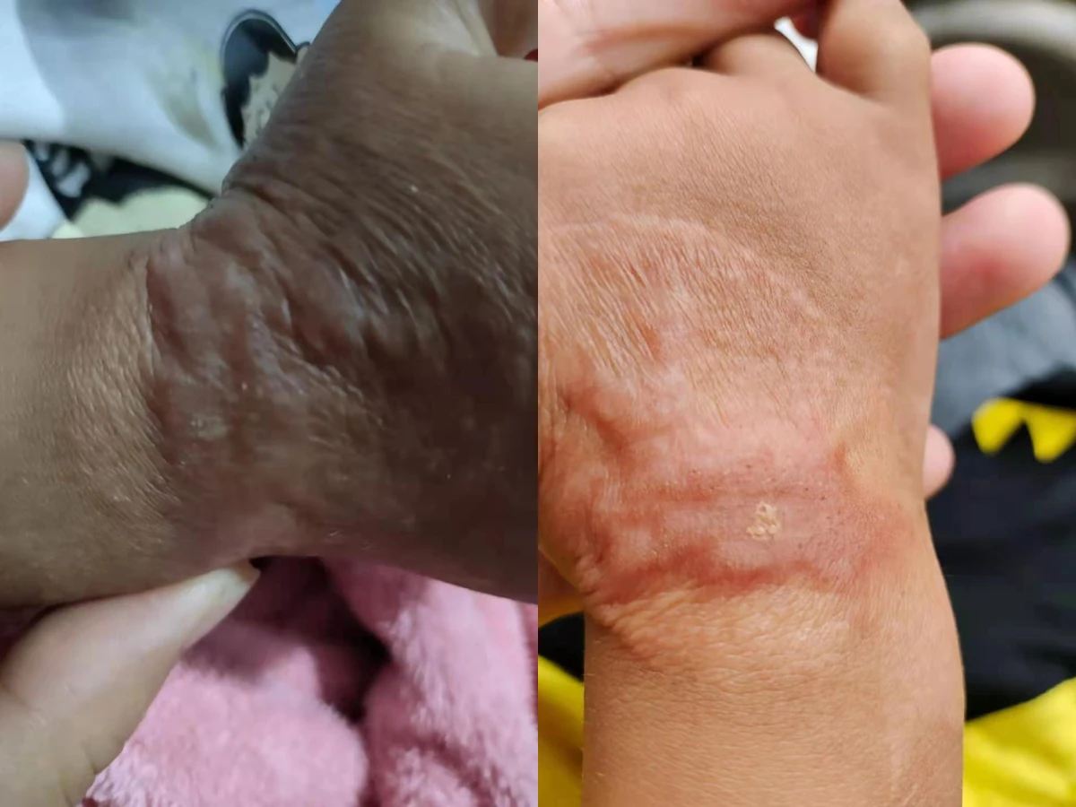 手腕增生疤痕改善记录