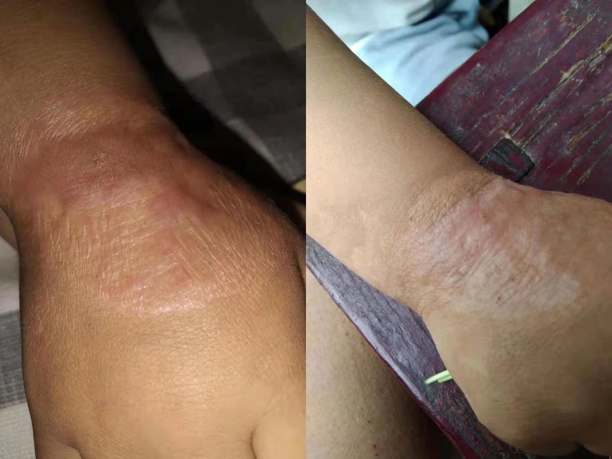肘部增生疤痕阶段修复