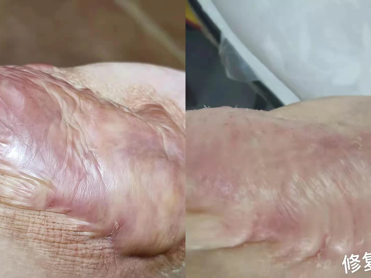 肘部增生疤痕阶段改善