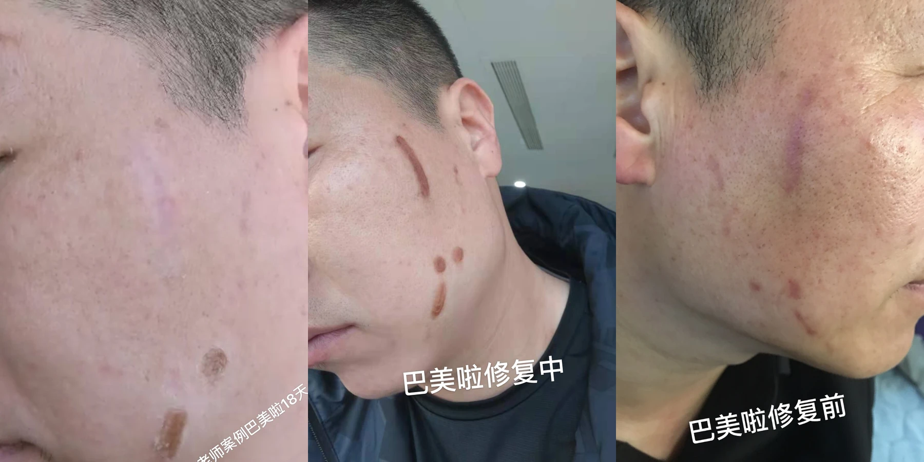面部外伤疤痕改善记录
