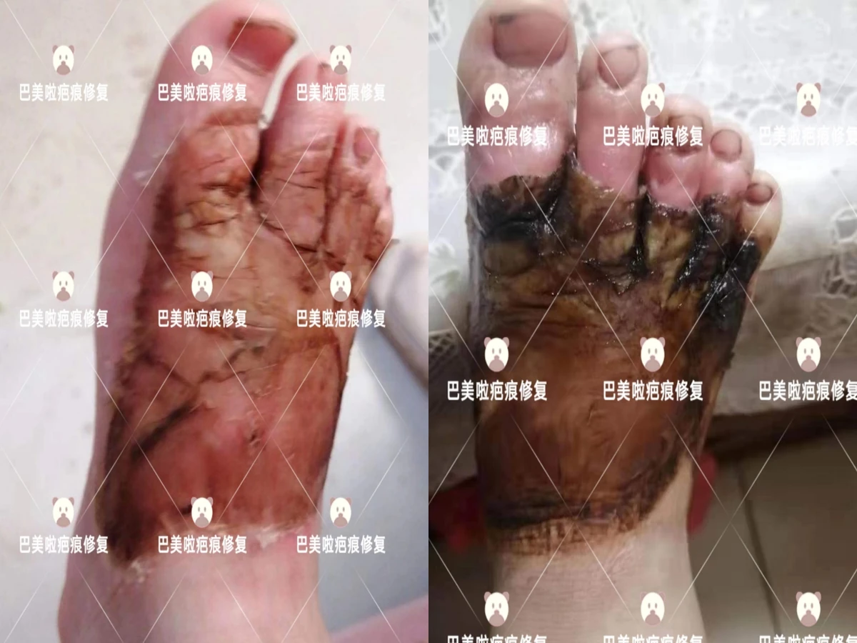 足部烧烫伤疤痕修复对比