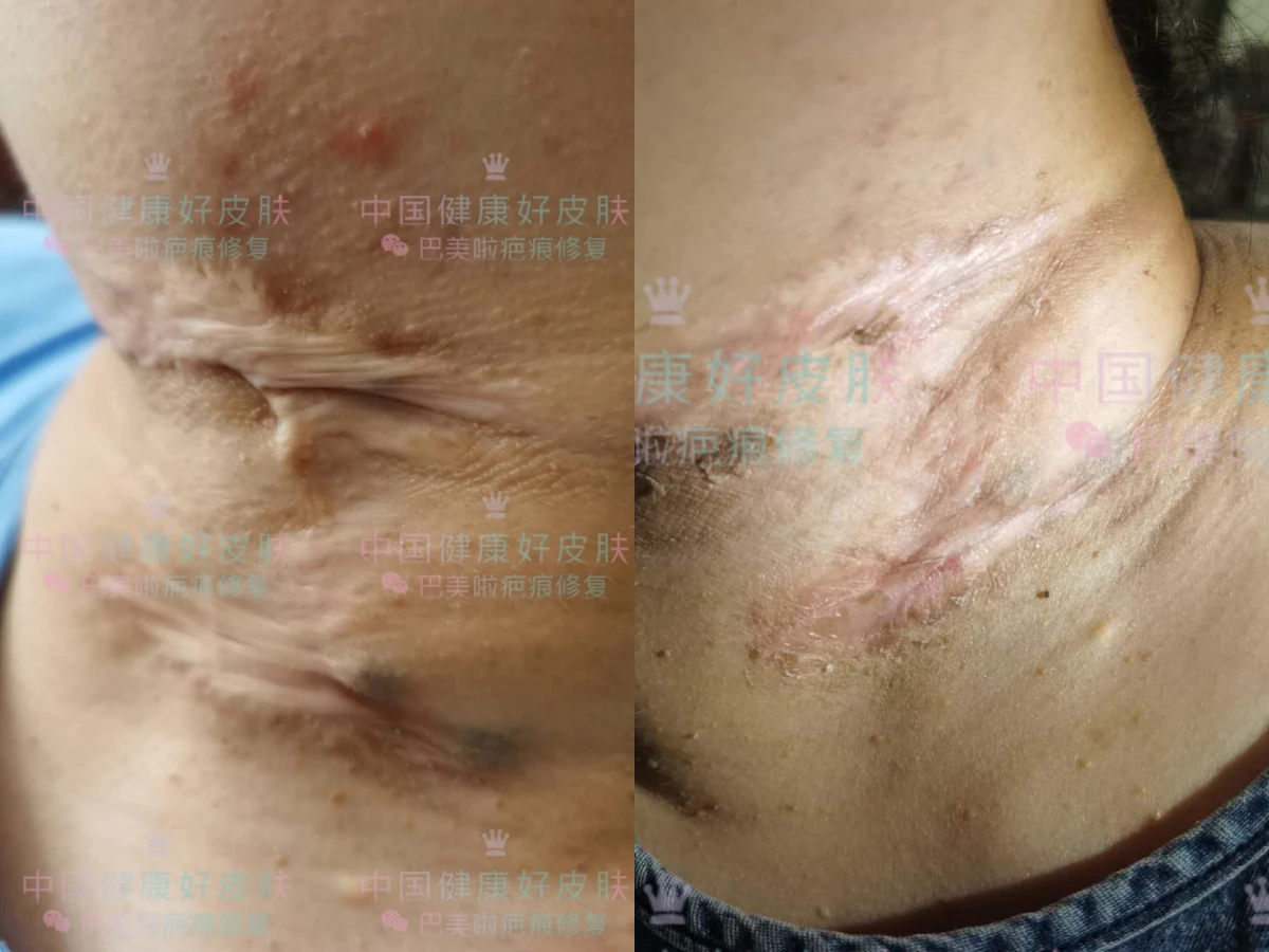腹部增生疤痕修复记录