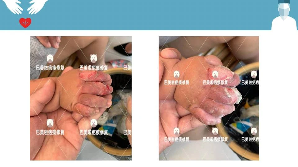 手部烧烫伤疤痕改善对比