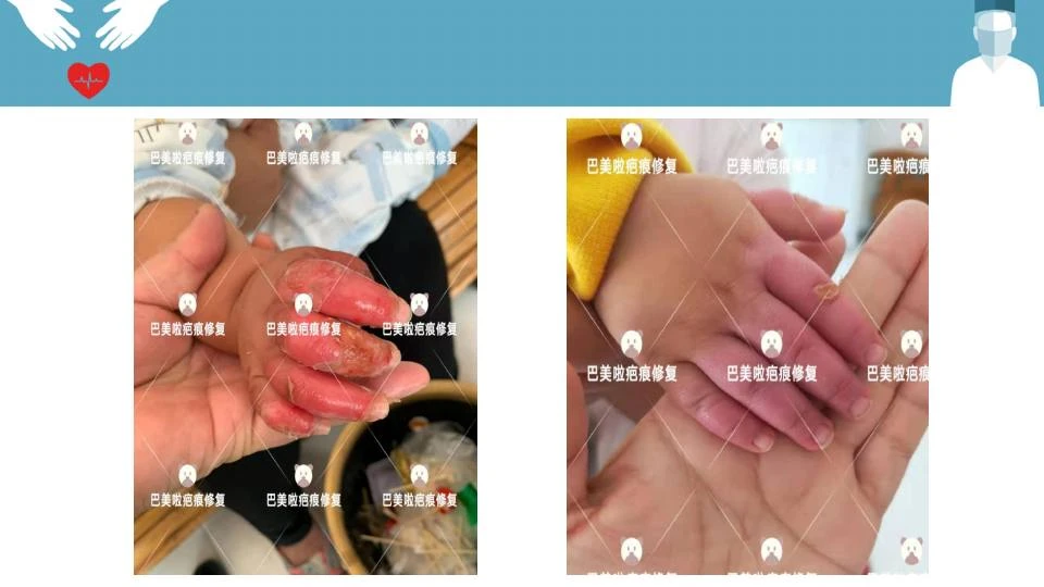 手掌创伤疤痕修复记录