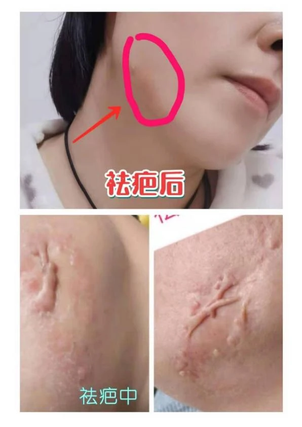 面颊增生疤痕改善记录