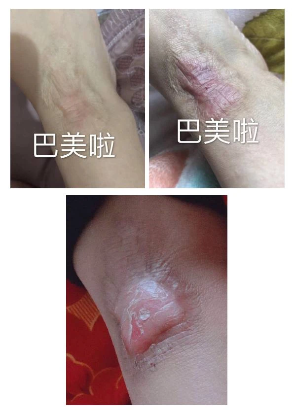 小腿增生疤痕阶段修复