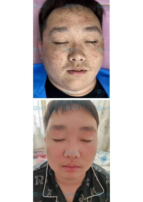 鼻面部雀斑管理记录